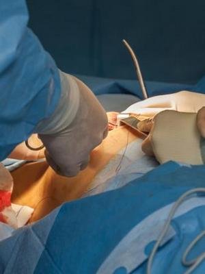 Sagging breast surgery