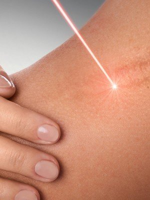 Laser breast lift